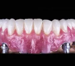 What Happens After You Get Dental Veneers?