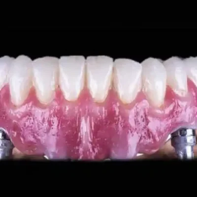 What Happens After You Get Dental Veneers?