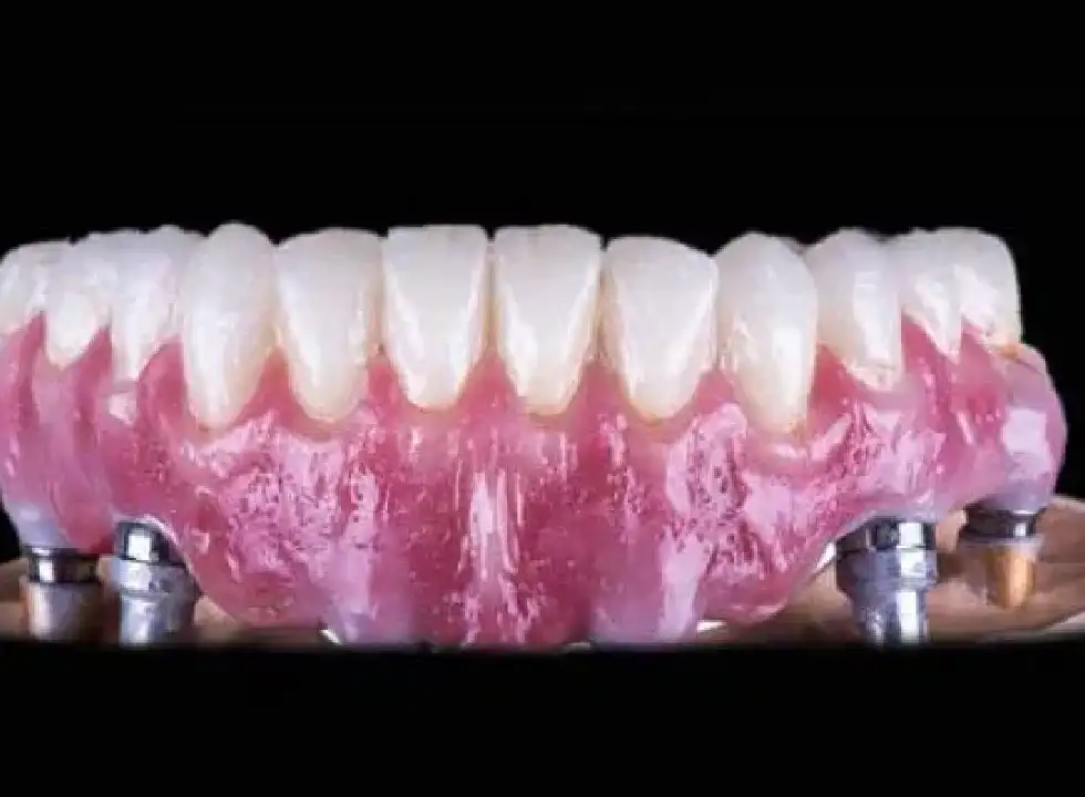 What Happens After You Get Dental Veneers?
